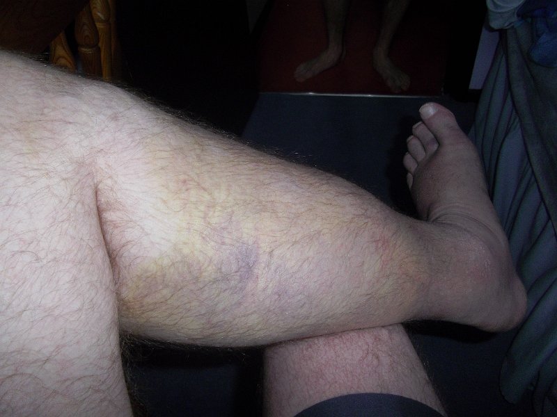 Tuesday 26th June 2012.JPG - More bruising and swelling